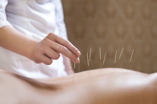 Come praticare l’agopuntura