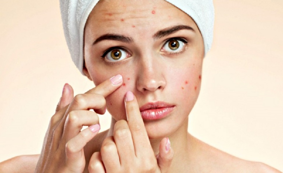 Cos’è l’acne